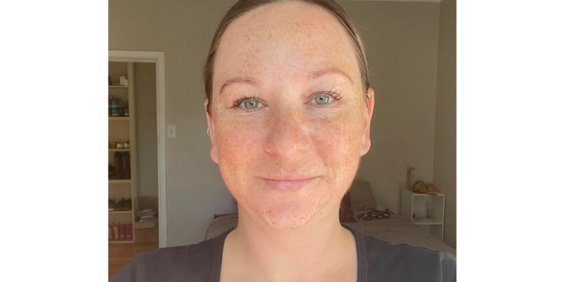 Skin Confidence Journey Story: Aroha, Thirties